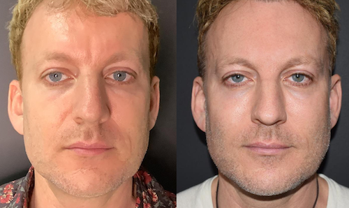 non surgical face lift before after lip doctor mississauga oakville